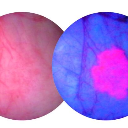 A bladder tumour as seen through a white light scope (L) and a blue light scope (R)