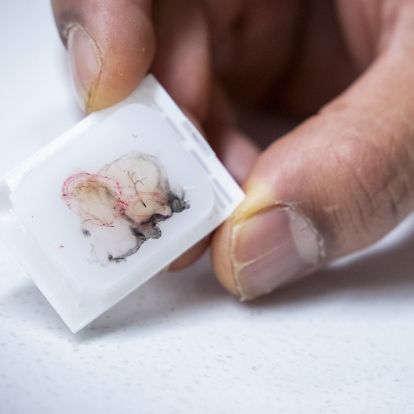 Tumour sample preserved in parrafin