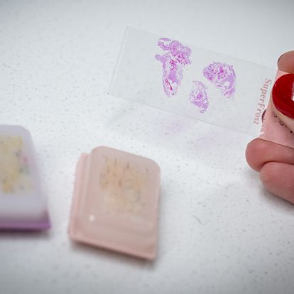 Tumour slides preserved in parrafin