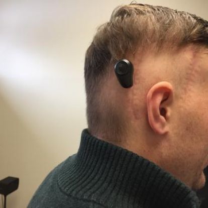 In the BAHA procedure, a titanium implant is surgically placed into the bone behind the ear.  Once the implant has healed in place, a sound processor is attached and activated, providing transmission of sound and significant hearing improvement for the patient.  Kingston's first BAHA recipient, Adam Pennock (pictured here), describes the technology as "very cool."