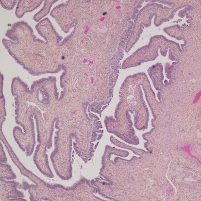 An image of cancerous tissue as seen through a microscope in the histology lab