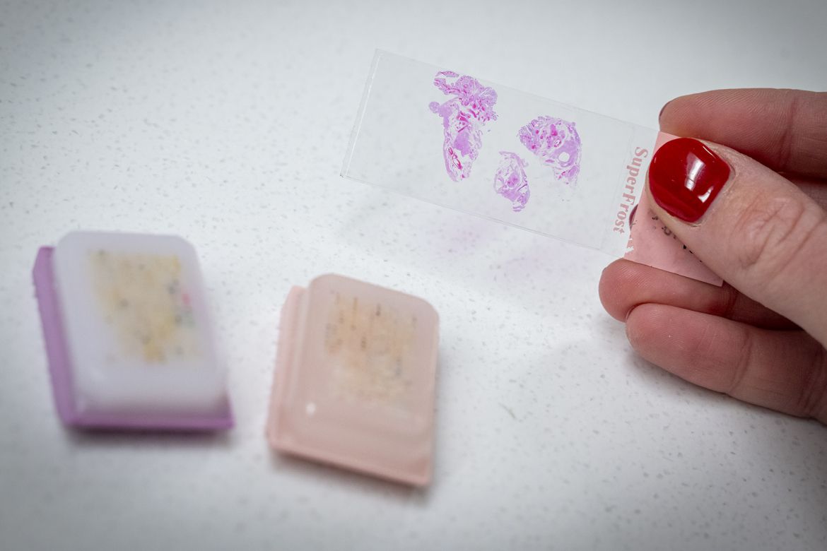 Tumour slides preserved in parrafin