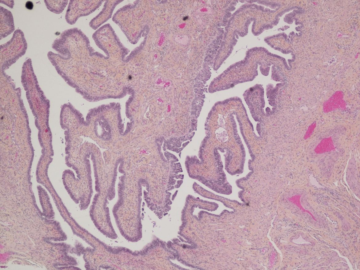 An image of cancerous tissue as seen through a microscope in the histology lab